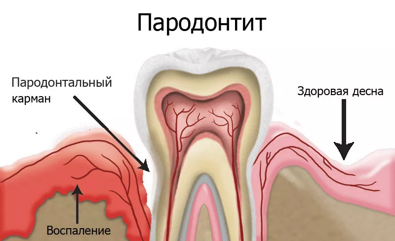 Пародонтит: диагностика, лечение и профилактика заболеваний десен - 5